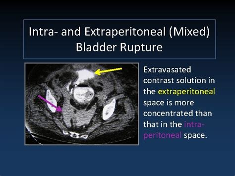 20k bladder tear test|deceleration bladder injury.